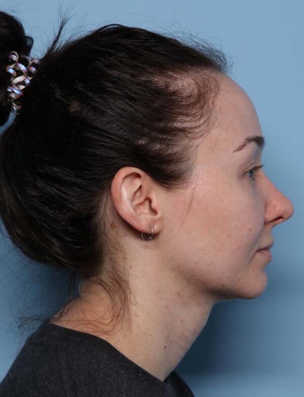 Rhinoplasty