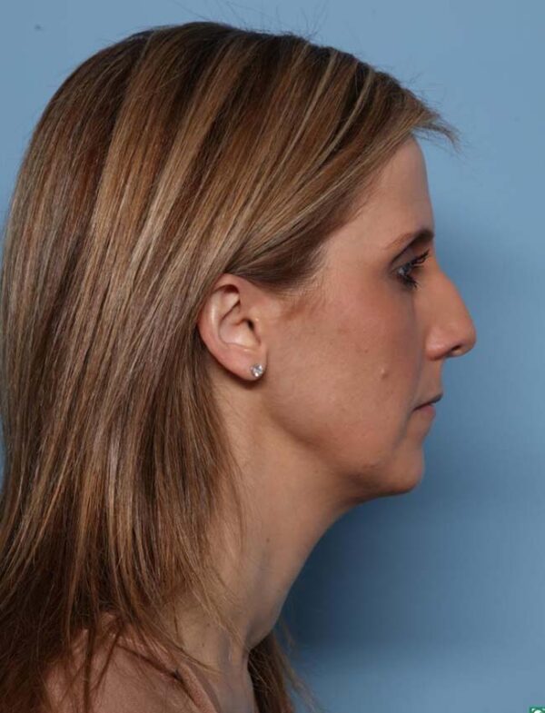 Rhinoplasty