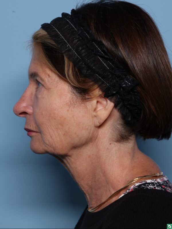 Blepharoplasty