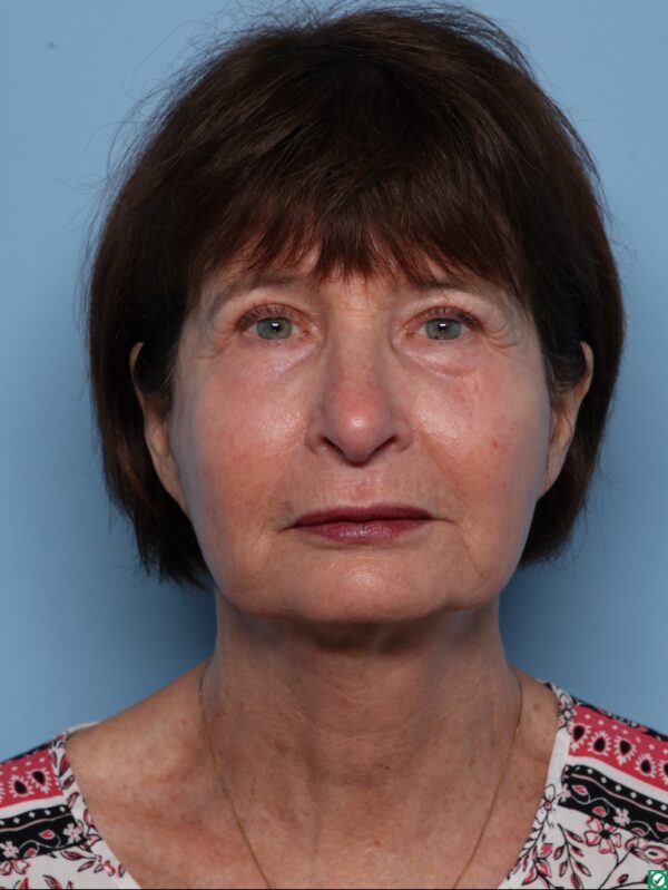 Blepharoplasty