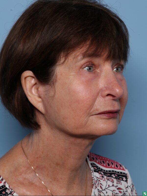 Blepharoplasty