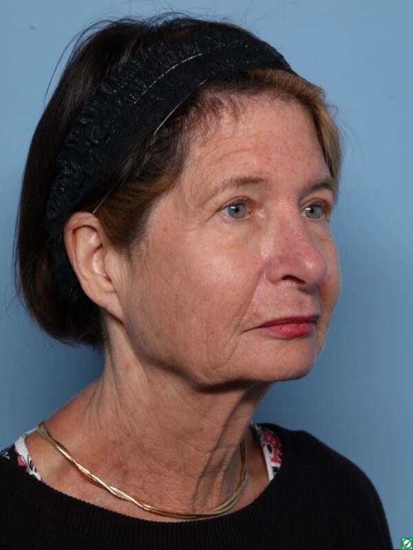 Blepharoplasty