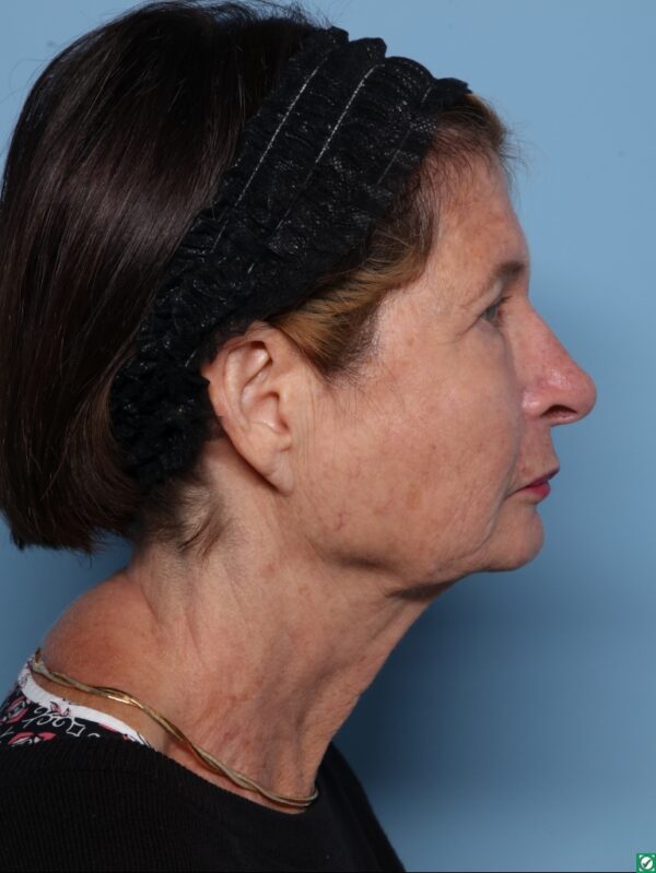 Blepharoplasty