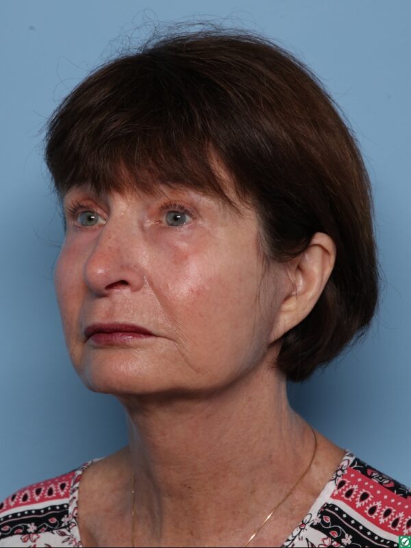 Blepharoplasty