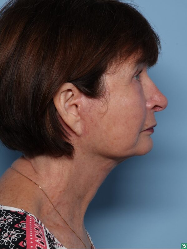 Blepharoplasty