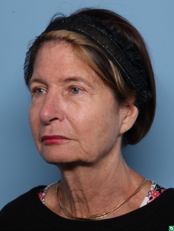 Blepharoplasty