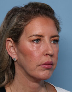 Chin Augmentation