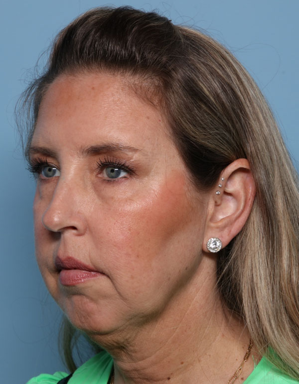 Chin Augmentation