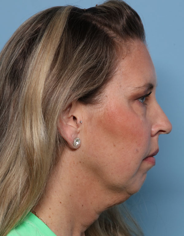 Chin Augmentation