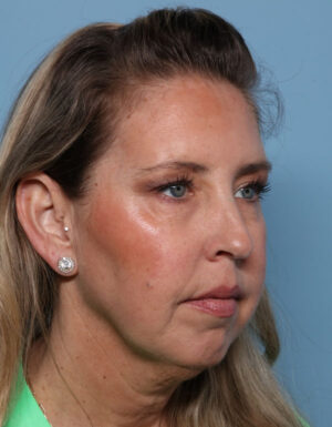 Chin Augmentation