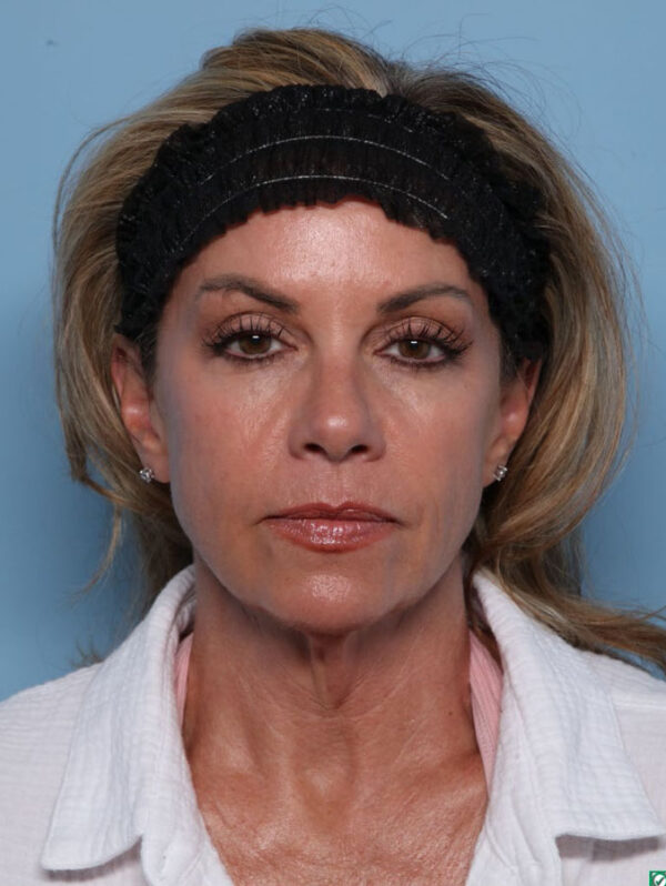 Facelift