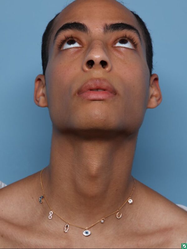 Rhinoplasty