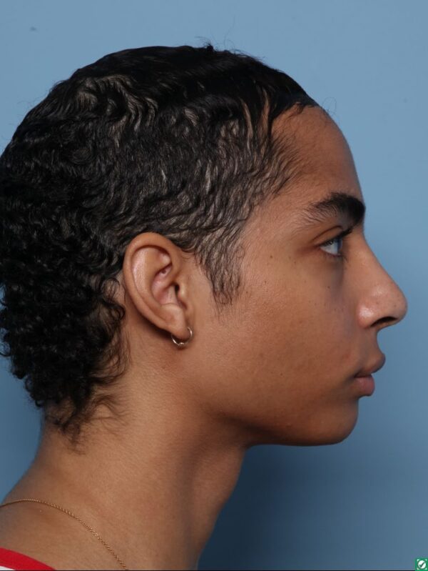 Rhinoplasty