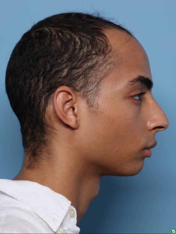 Hairline Lowering