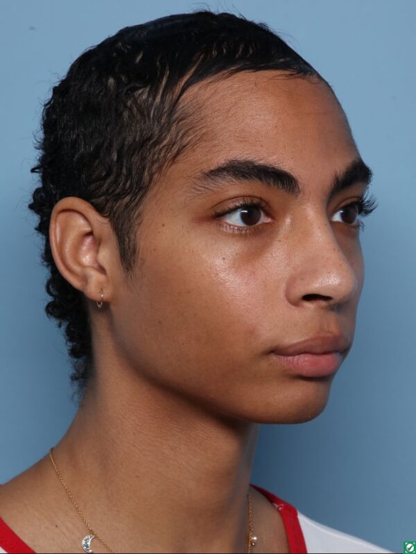 Hairline Lowering