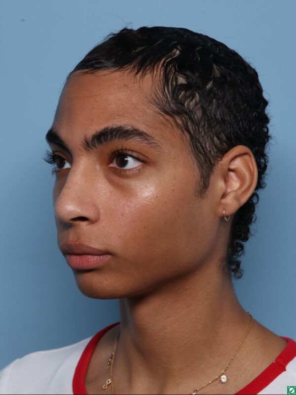 Hairline Lowering