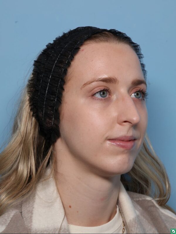 Rhinoplasty