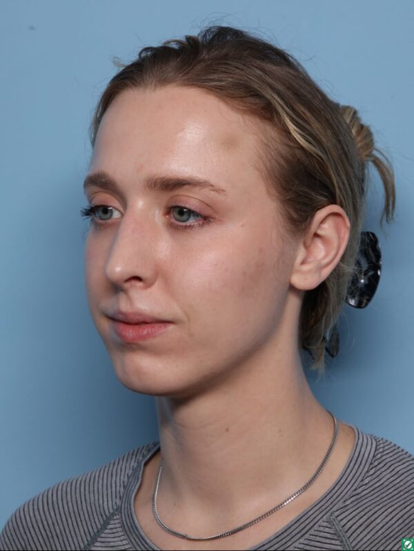 Rhinoplasty