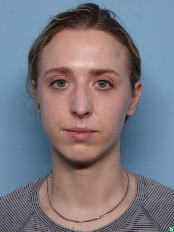 Rhinoplasty