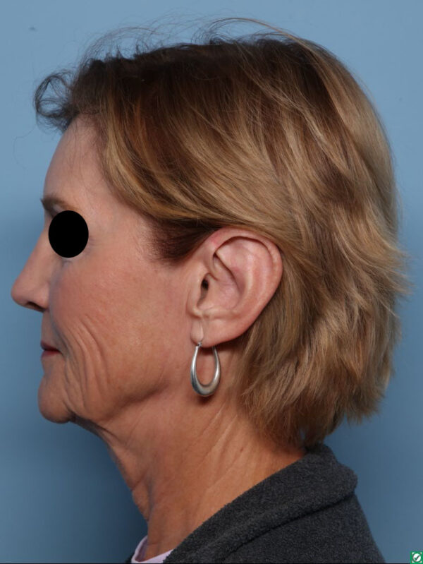 Rhinoplasty