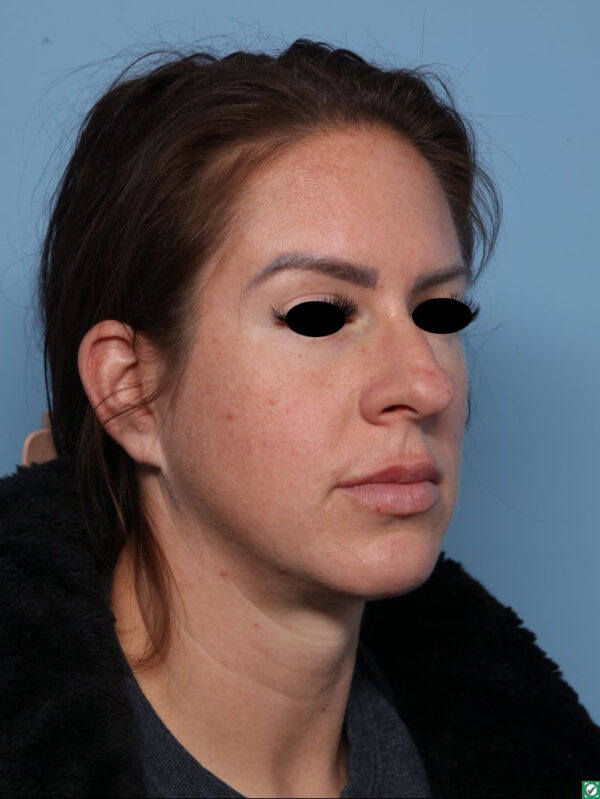 Rhinoplasty