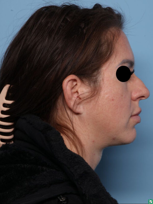 Rhinoplasty