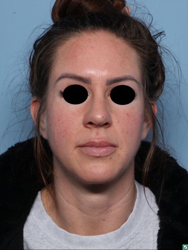 Rhinoplasty