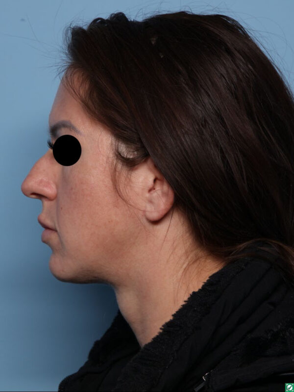 Rhinoplasty