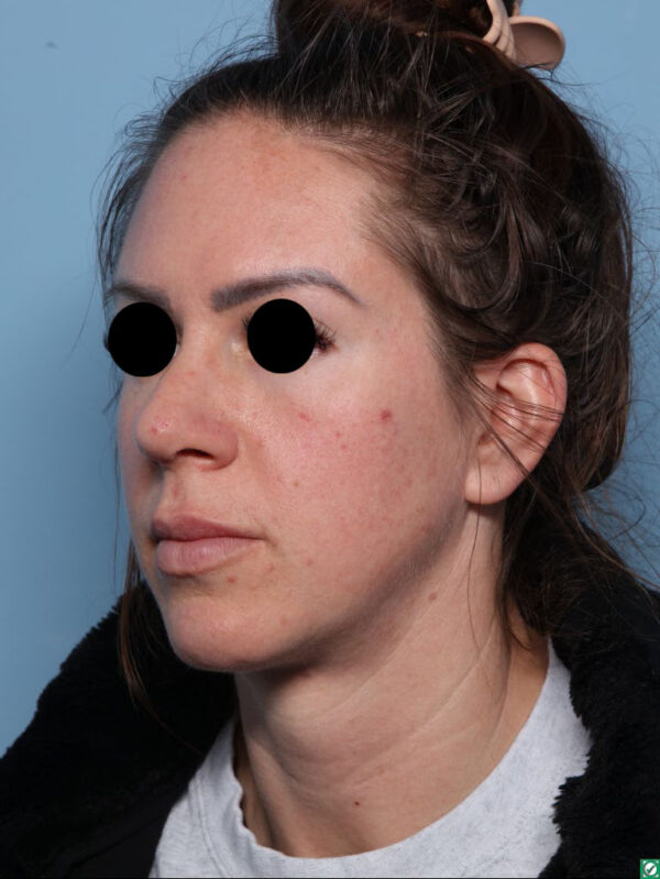 Rhinoplasty