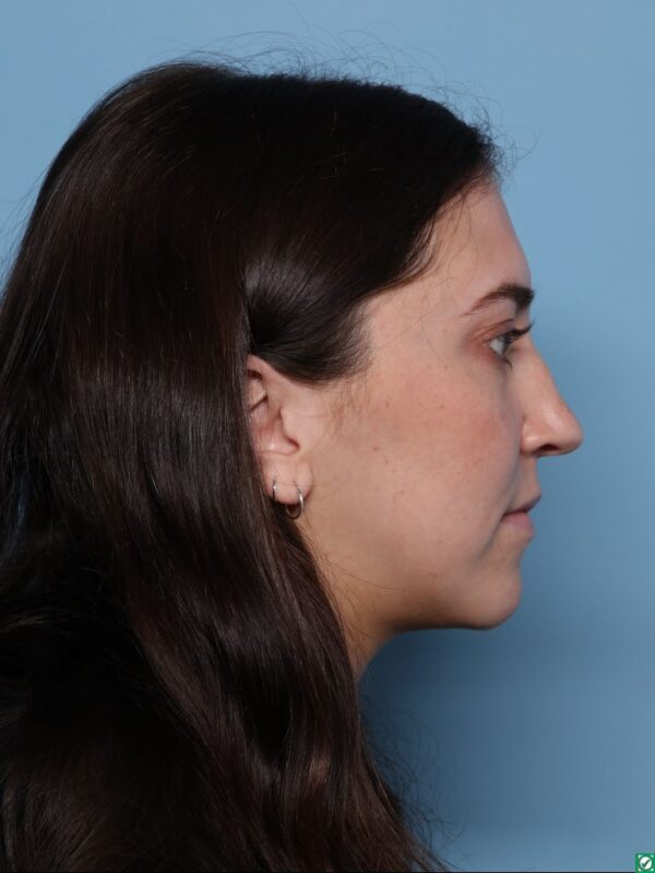 Rhinoplasty