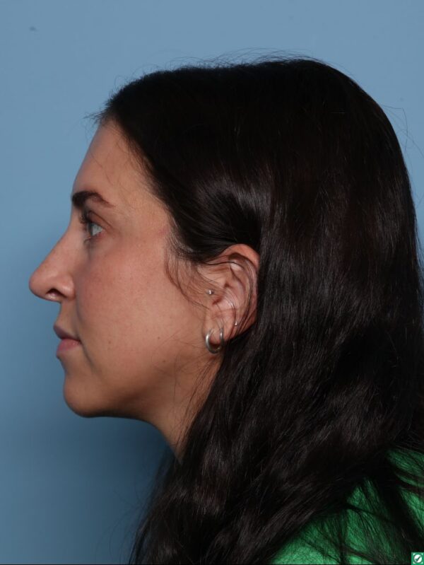 Rhinoplasty