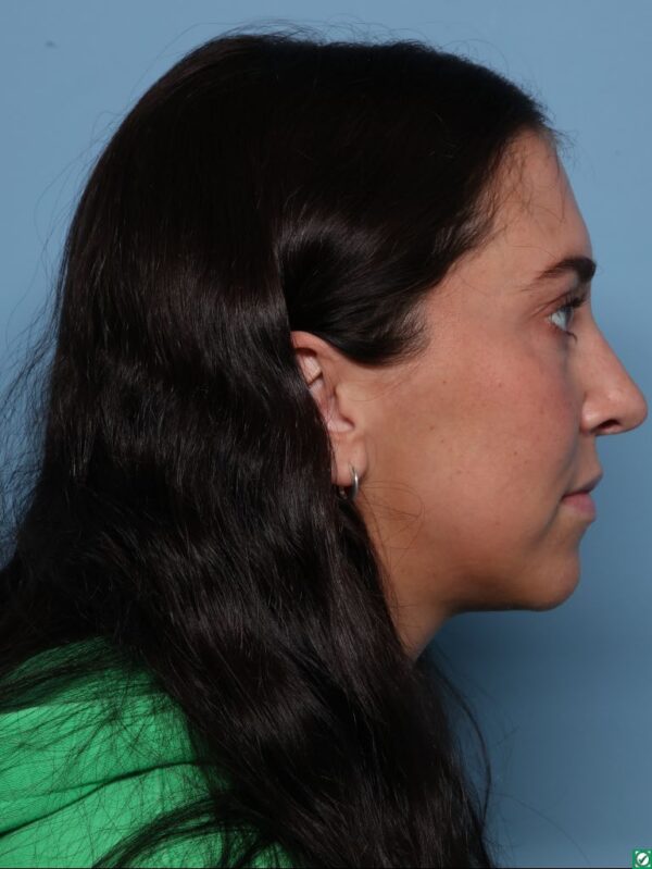 Rhinoplasty