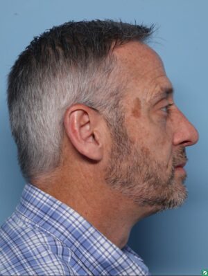 Rhinoplasty