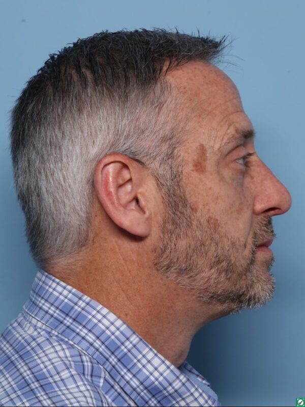 Rhinoplasty