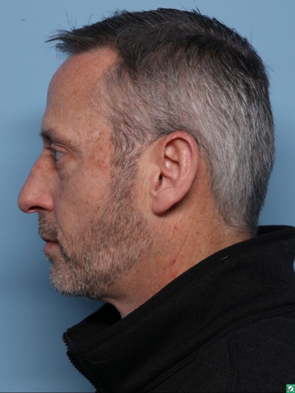 Rhinoplasty