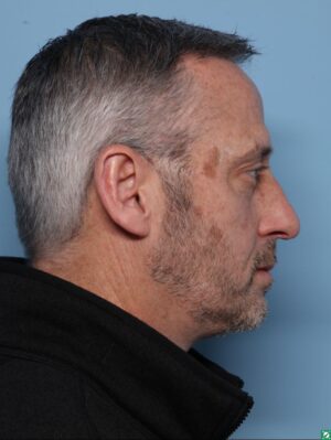 Rhinoplasty