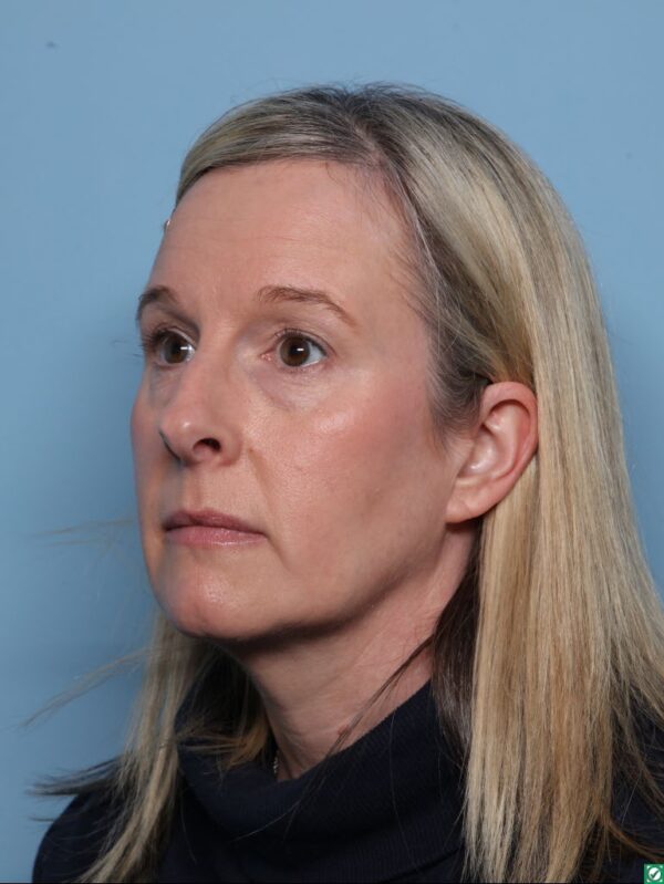 Rhinoplasty