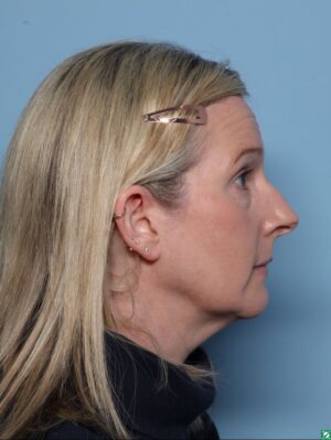 Rhinoplasty