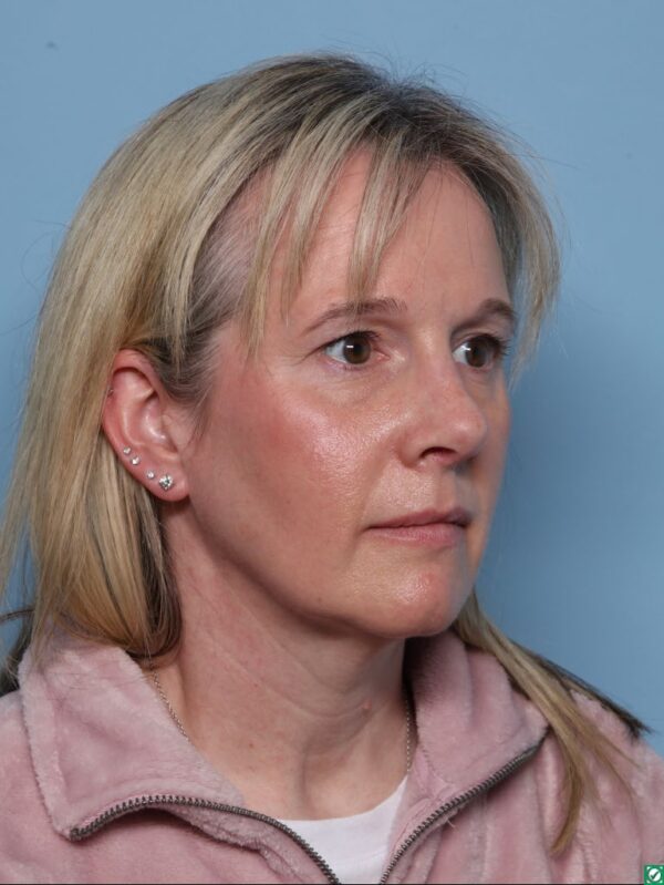 Rhinoplasty