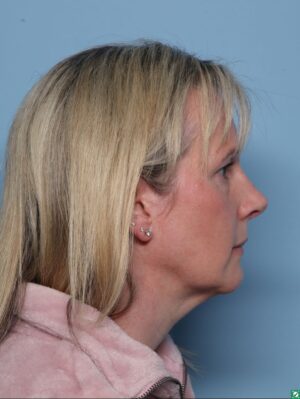 Rhinoplasty