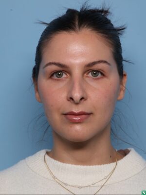 Rhinoplasty