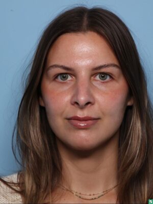 Rhinoplasty
