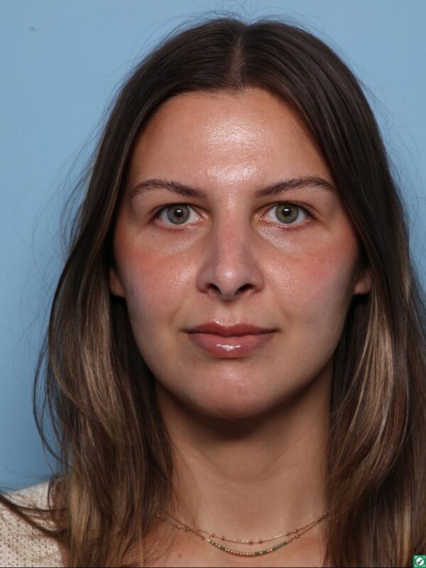 Rhinoplasty