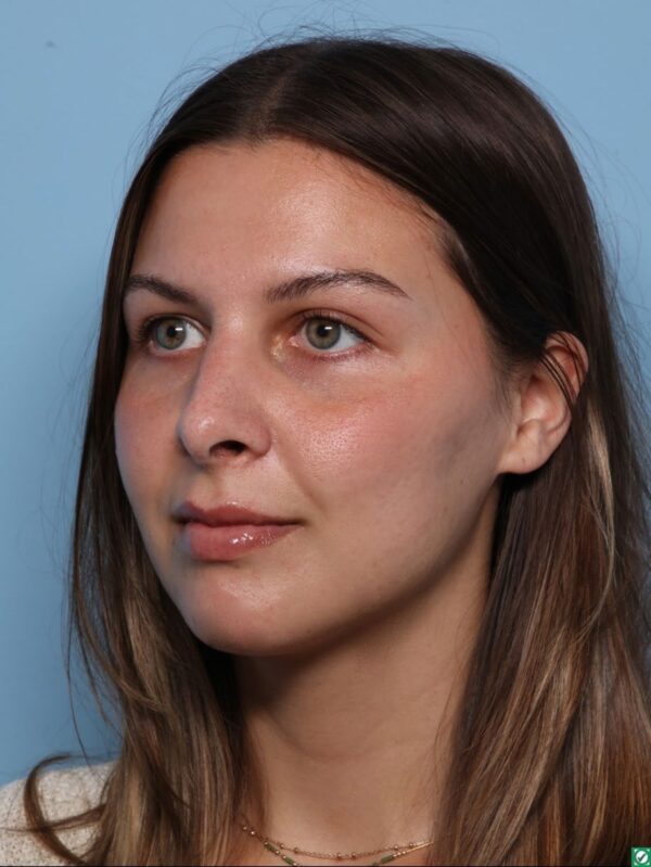 Rhinoplasty
