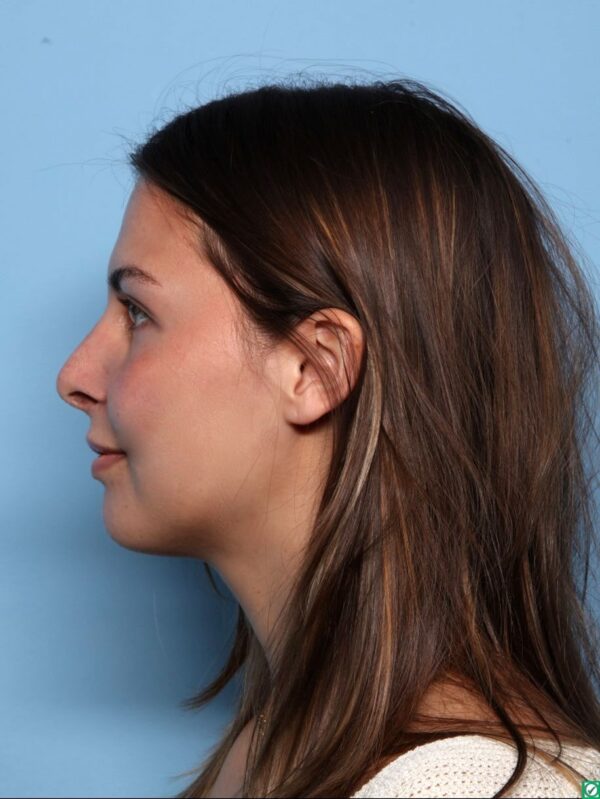 Rhinoplasty