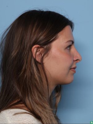 Rhinoplasty