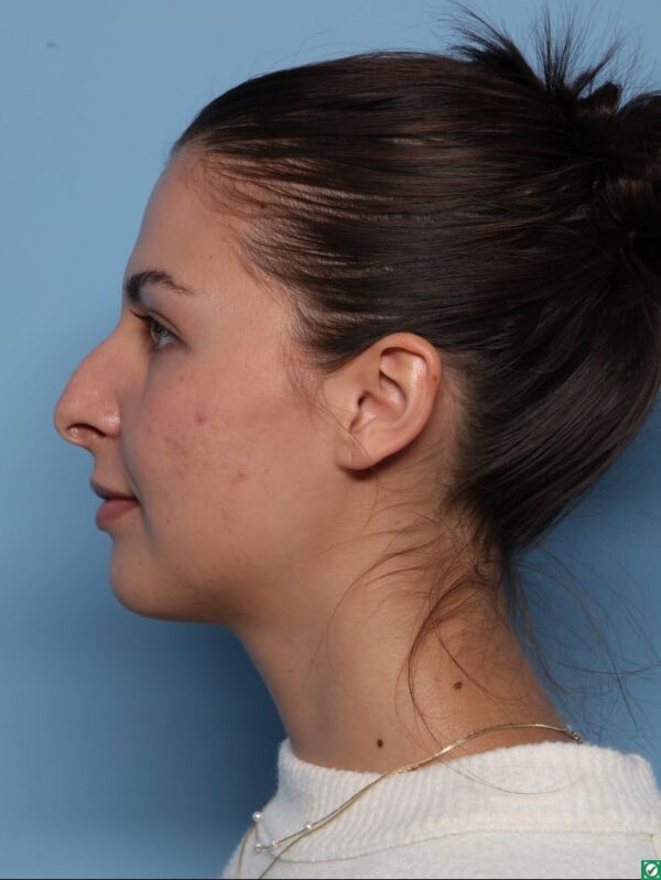 Rhinoplasty