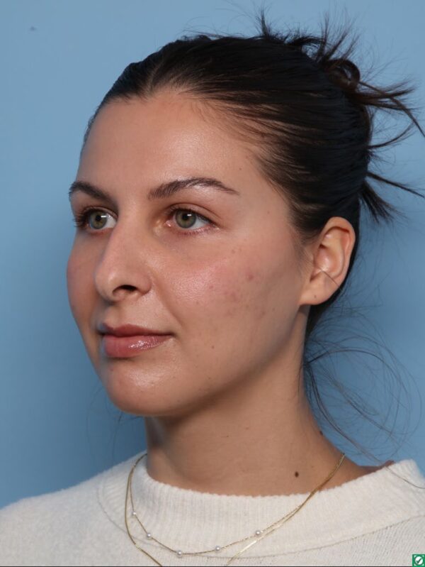 Rhinoplasty