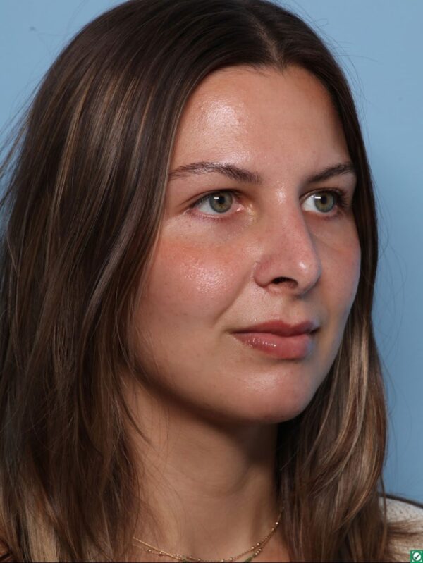 Rhinoplasty