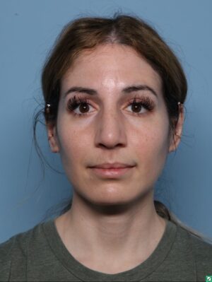 Rhinoplasty